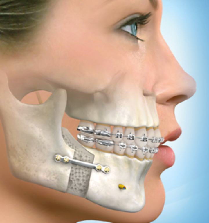 Chirurgie
                        orthognatique & orthodontique