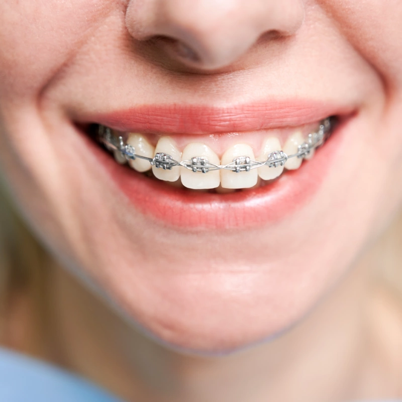 photo appareil dentaire