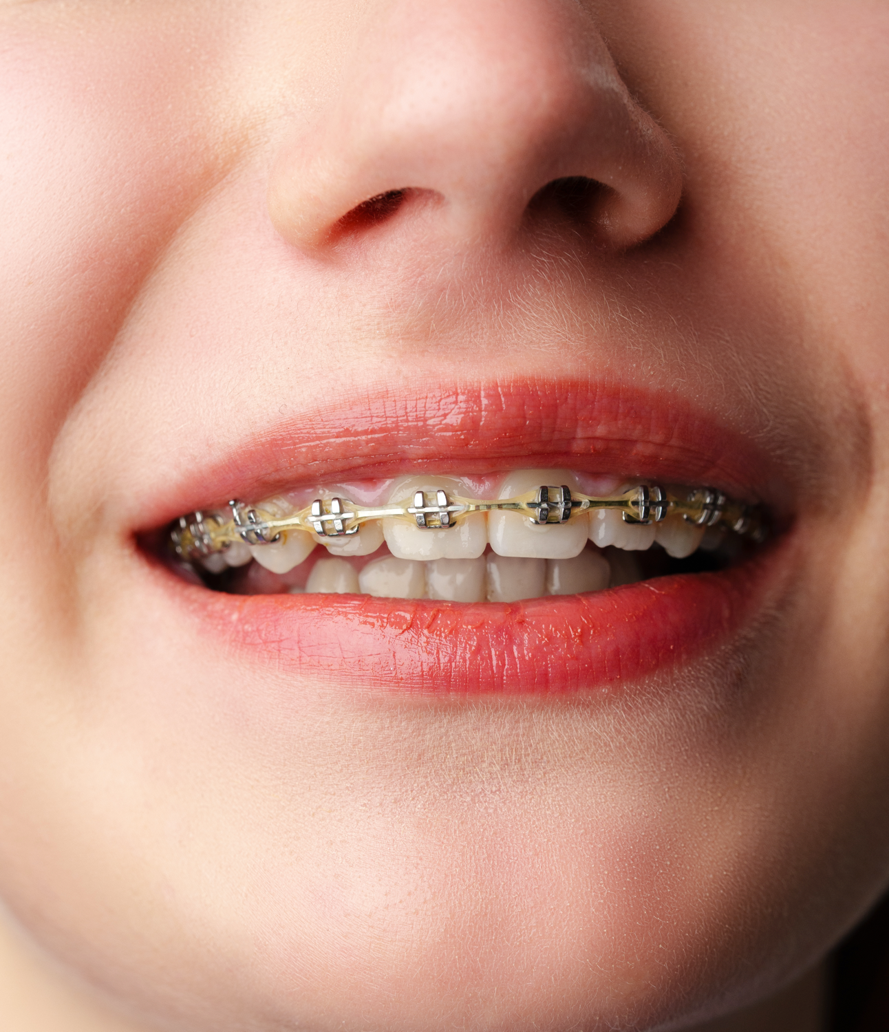 Pose appareil orthodontique